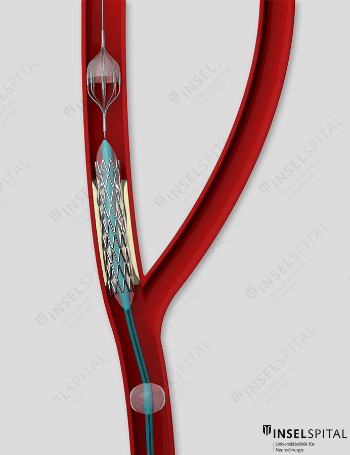 Stent 3d Visualisierung
