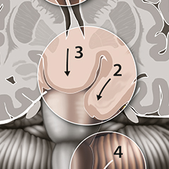 herniation thumbnail image