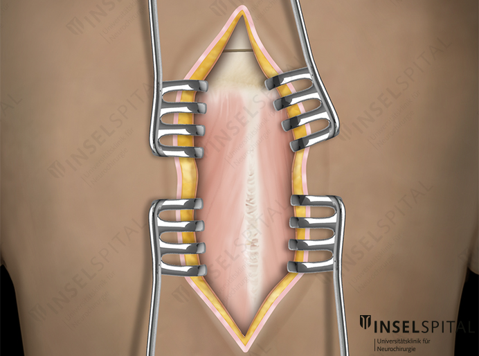 Illustration infratentorial approach