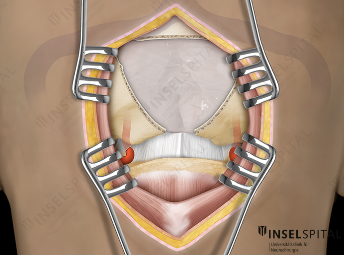 Illustration infratentorial approach