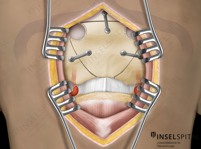 Illustration infratentorial approach