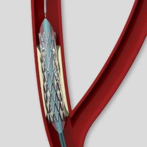 stent thumbnail image