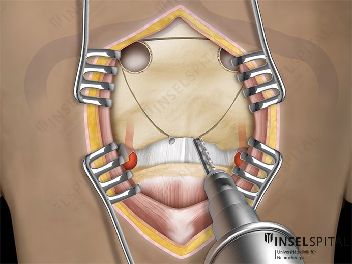 Illustration infratentorial approach