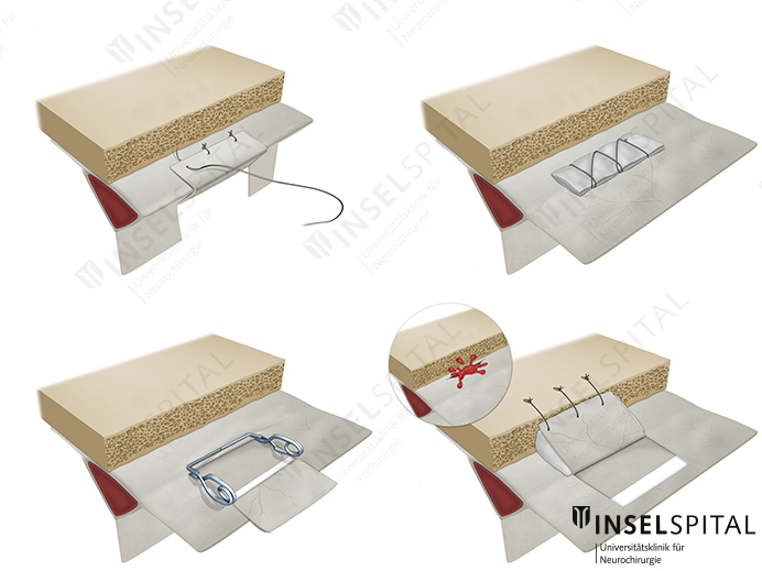 Illustration Sinus laceration