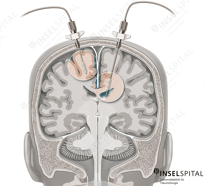 Illustration Herniation