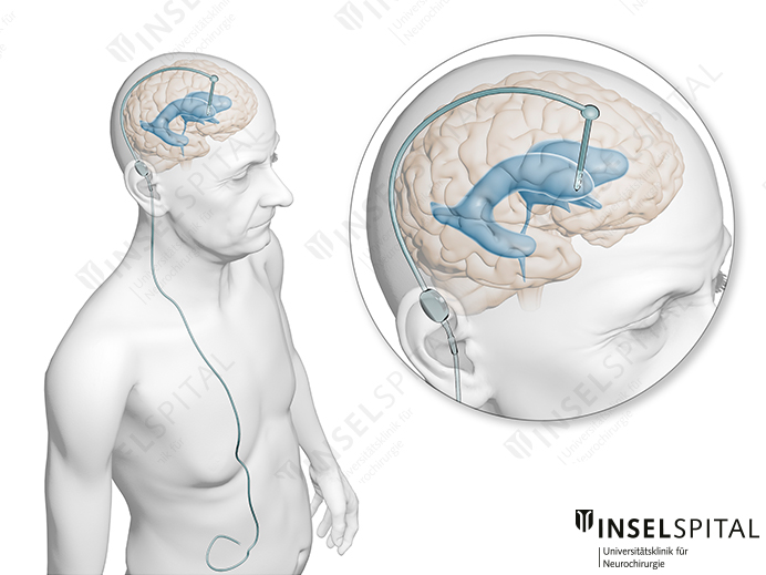 Illustration Hydrocephalus shunt