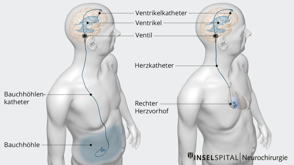 Illustration Normaldruckhydrocephalus Katheter