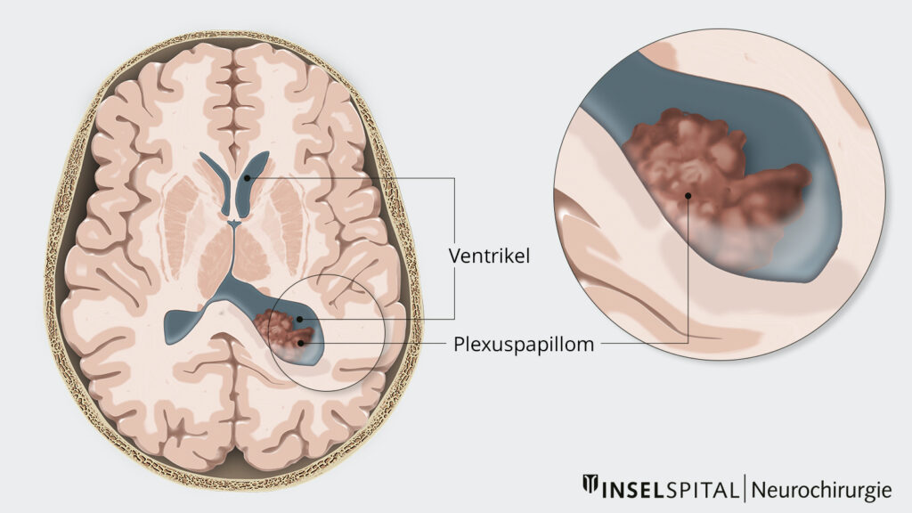 Illustration Plexuspapillom