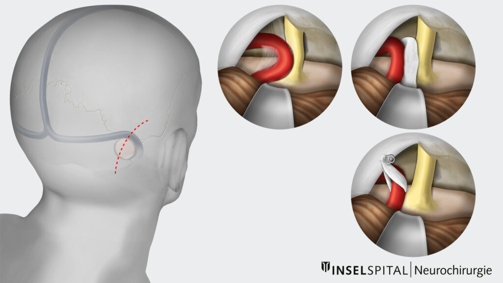 Illustration Operation Trigeminusneuralgie