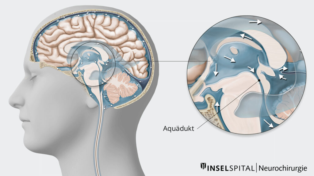 Illustration Aquäduktstenose Ventrikelsystem