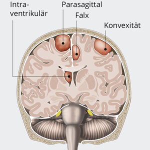 meningeom thumbnail image