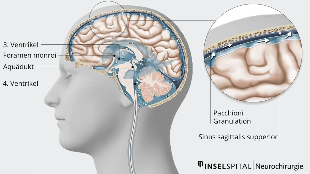 Illustration Hydrocephalus Ventrikelsystem