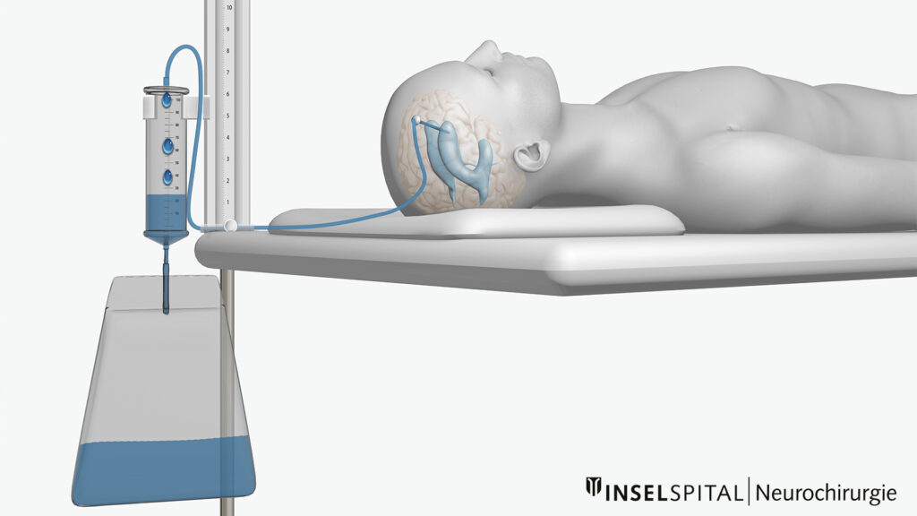 Illustration Hydrocephalus Massnahme