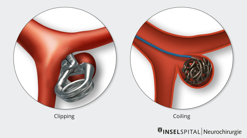 Illustration Aneurysma Clipping und Coiling