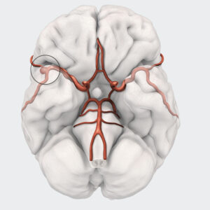 aneurysma thumbnail image