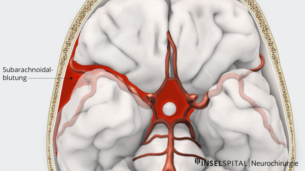 Illustration Subarachnoidalblutung  Aneurysma Ruptur