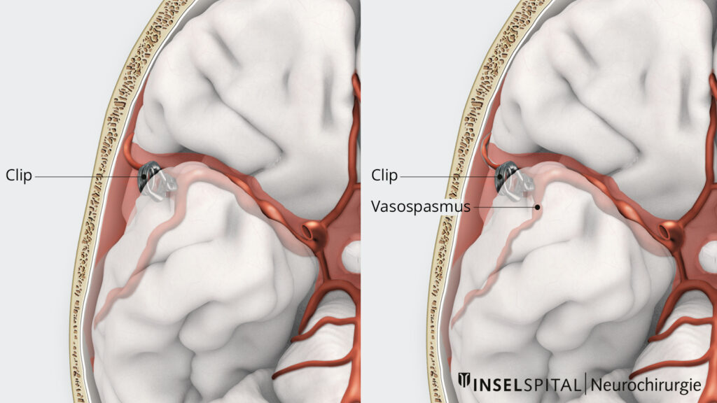 Illustration Clipping Aneurysma