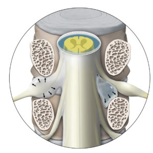 Spontaneous Intracranial Hypotension thumbnail image